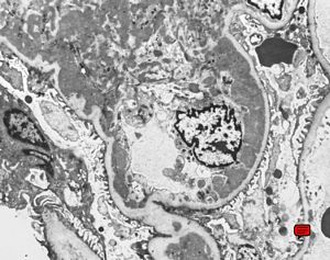 M,19y. | membranous glomerulopathy - lupus erythematodes st. IV